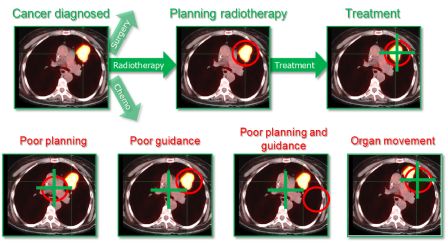 radiotherapy til web 180 pxl bredt.png